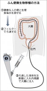 図は日経新聞Web2015年7月3日よりWeb上に発表されたもので、大腸内視鏡による移植)